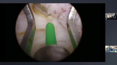 Procédure HoLEP : Gentilly - Cas n°2 - Enregistrement Polyclinique Gentilly 2020-01-17