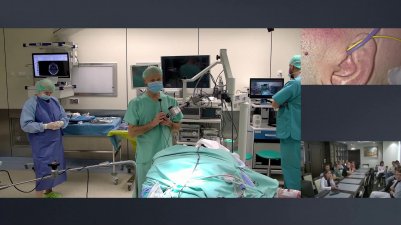 Middle fossa approach. Removal of vestibular schwannoma.