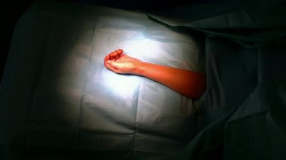 Ostéotomie Modélisée pour la correction d'un cal vicieux du radius distal.