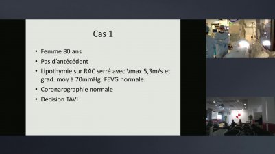 Procédure TAVI - Hopital HENRI MONDOR