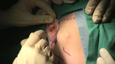 Usunięcie nowotworu ślinianki przyusznej