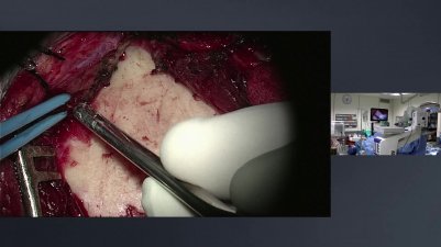 Facial schwannoma 2019-09-04 15:09