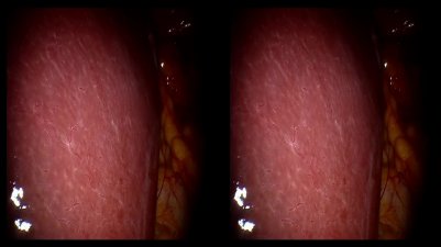 Surrénale Robot 3D 2018-12-13