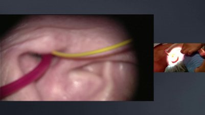 The endolymphatic sac tumor removal - 28.06.2019